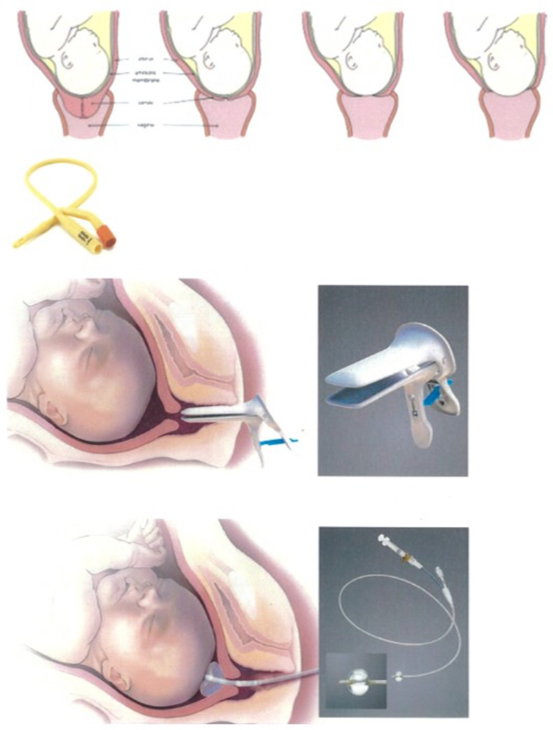 Cervical Ripening Balloon