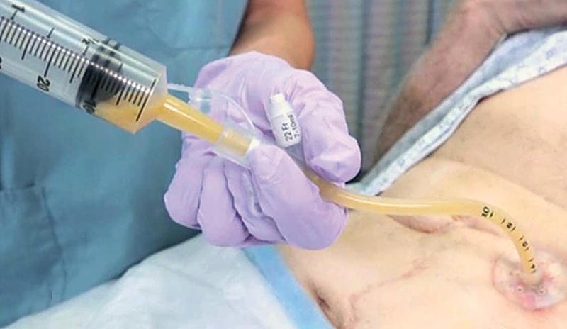Percutaneous Endoscopic Gastrostomy Application