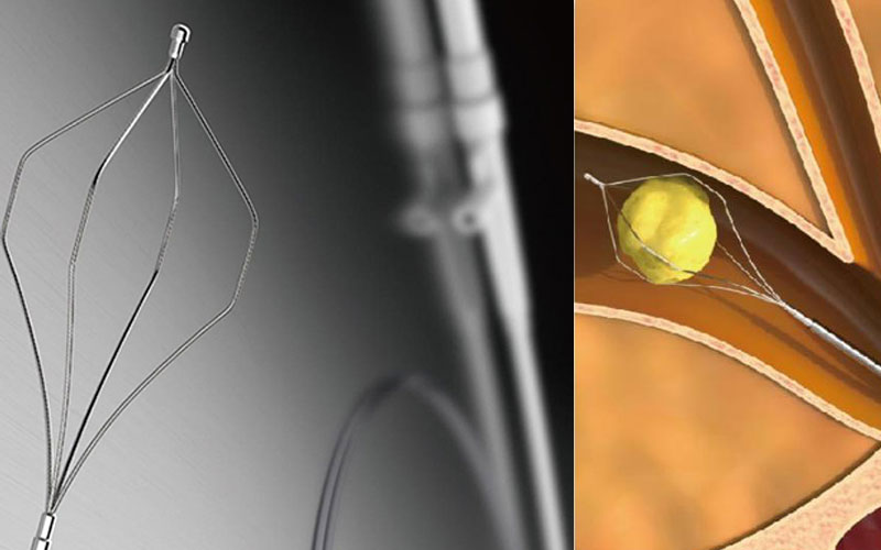 Endoscope Stone Extraction Basket Usage